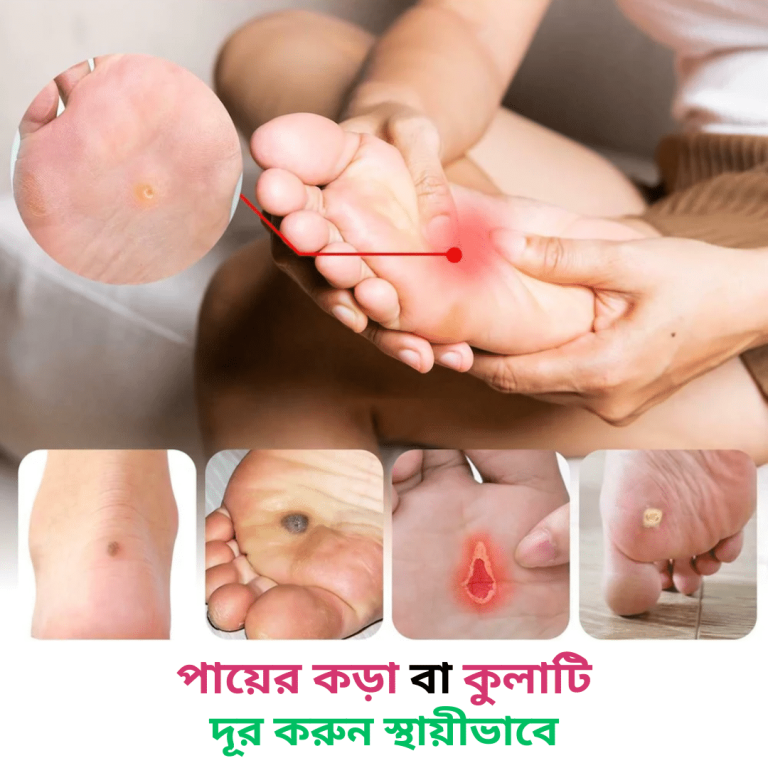কর্ন,বয়রা, হাড়কাঁটা, হাড়গোঁজা রিমুভার জেল